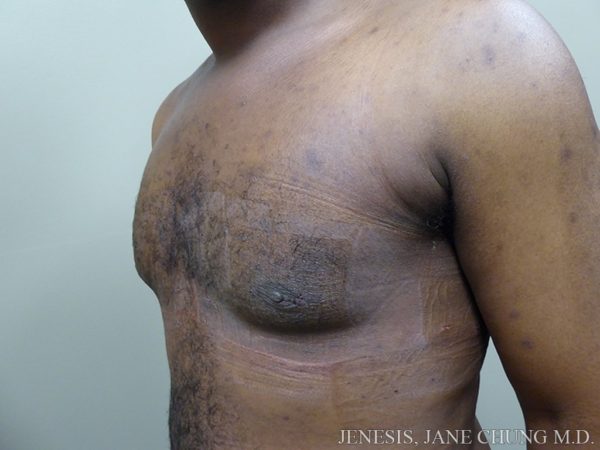 Gynecomastia