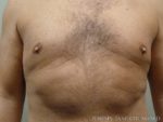 Gynecomastia