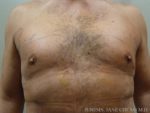 Gynecomastia