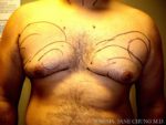 Gynecomastia