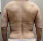 Arms & Upper Body Liposuction