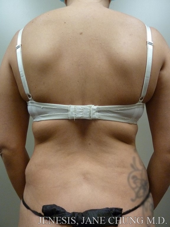 Arms & Upper Body Liposuction