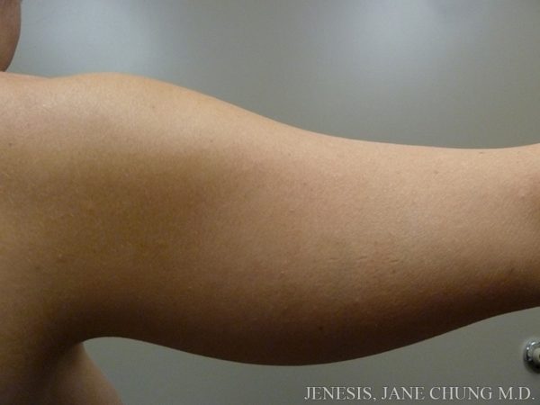 Arms & Upper Body Liposuction