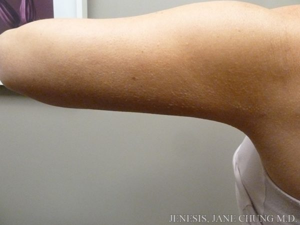 Arms & Upper Body Liposuction