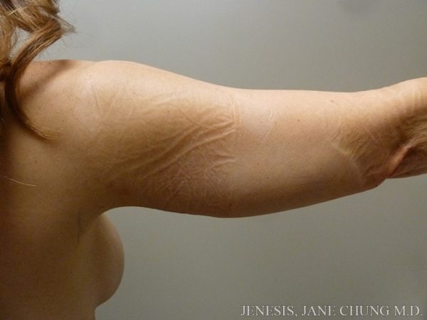 Arms & Upper Body Liposuction