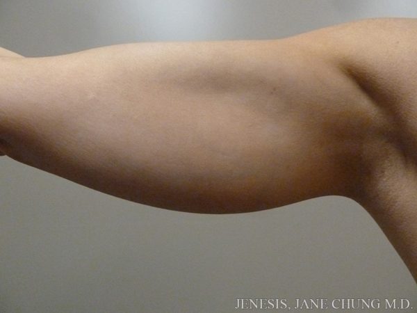 Arms & Upper Body Liposuction