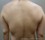 Arms & Upper Body Liposuction