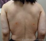 Arms & Upper Body Liposuction