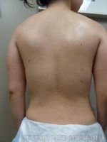 Arms & Upper Body Liposuction