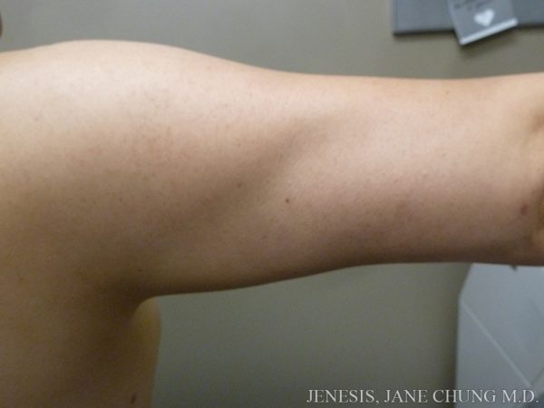 Arms & Upper Body Liposuction