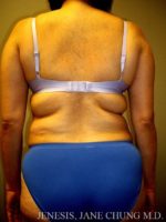 Arms & Upper Body Liposuction