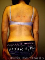 Arms & Upper Body Liposuction