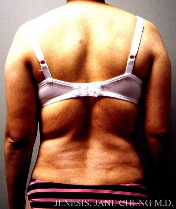 Arms & Upper Body Liposuction