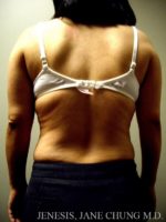 Arms & Upper Body Liposuction