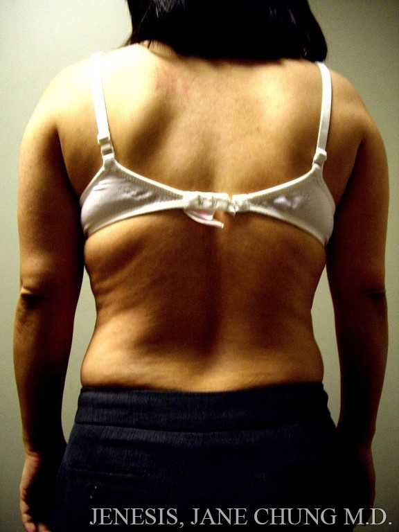 Arms & Upper Body Liposuction
