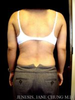 Arms & Upper Body Liposuction