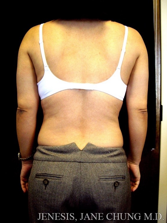 Arms & Upper Body Liposuction