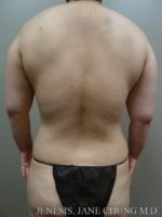 Arms & Upper Body Liposuction