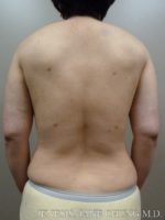 Arms & Upper Body Liposuction