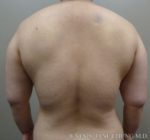 Arms & Upper Body Liposuction