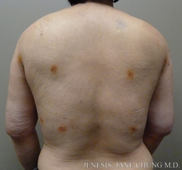 Arms & Upper Body Liposuction