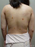 Arms & Upper Body Liposuction