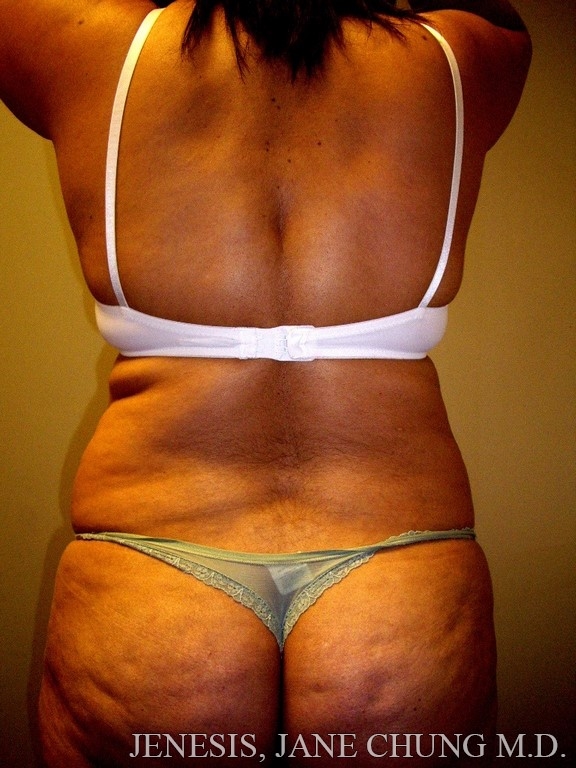 Arms & Upper Body Liposuction