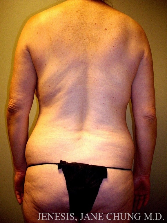 Arms & Upper Body Liposuction