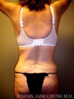 Arms & Upper Body Liposuction