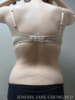 Arms & Upper Body Liposuction