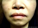 Buccal Fat Removal