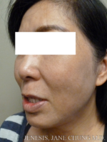 Buccal Fat Removal