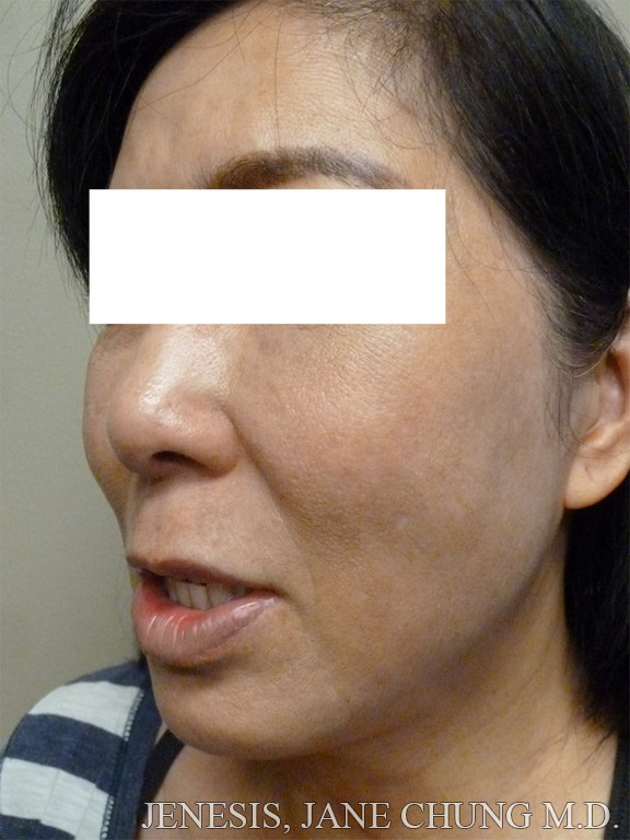 Buccal Fat Removal