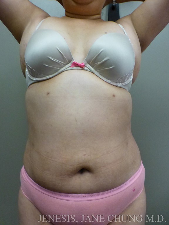 3D Micro Lipo™