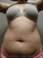 3D Micro Lipo™