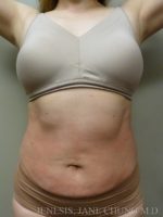 3D Micro Lipo™