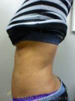 3D Micro Lipo™