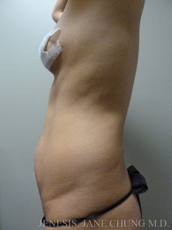 3D Micro Lipo™