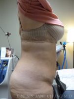 3D Micro Lipo™