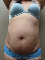 3D Micro Lipo™