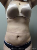 3D Micro Lipo™