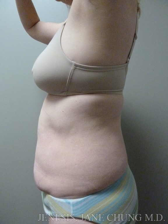 3D Micro Lipo™