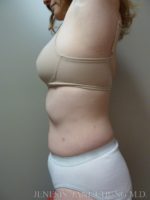 3D Micro Lipo™