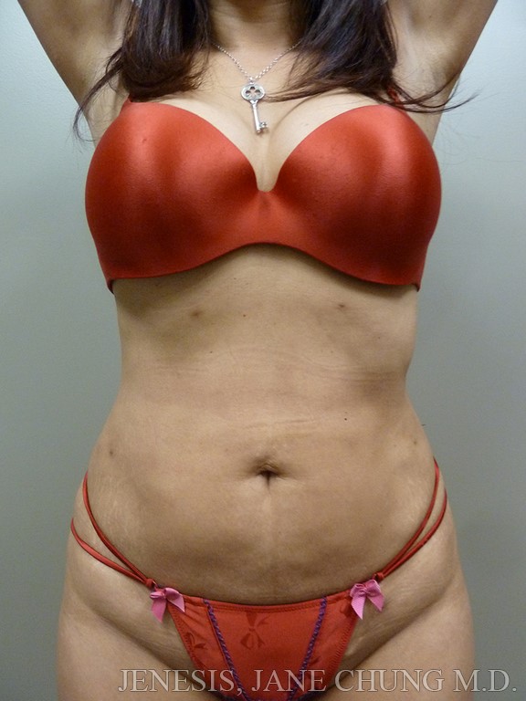 3D Micro Lipo™