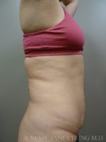 3D Micro Lipo™