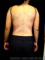 3D Micro Lipo™