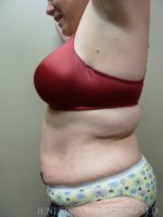 3D Micro Lipo™