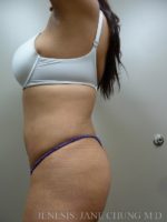 3D Micro Lipo™