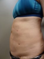 Revision Liposuction