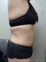 Revision Liposuction